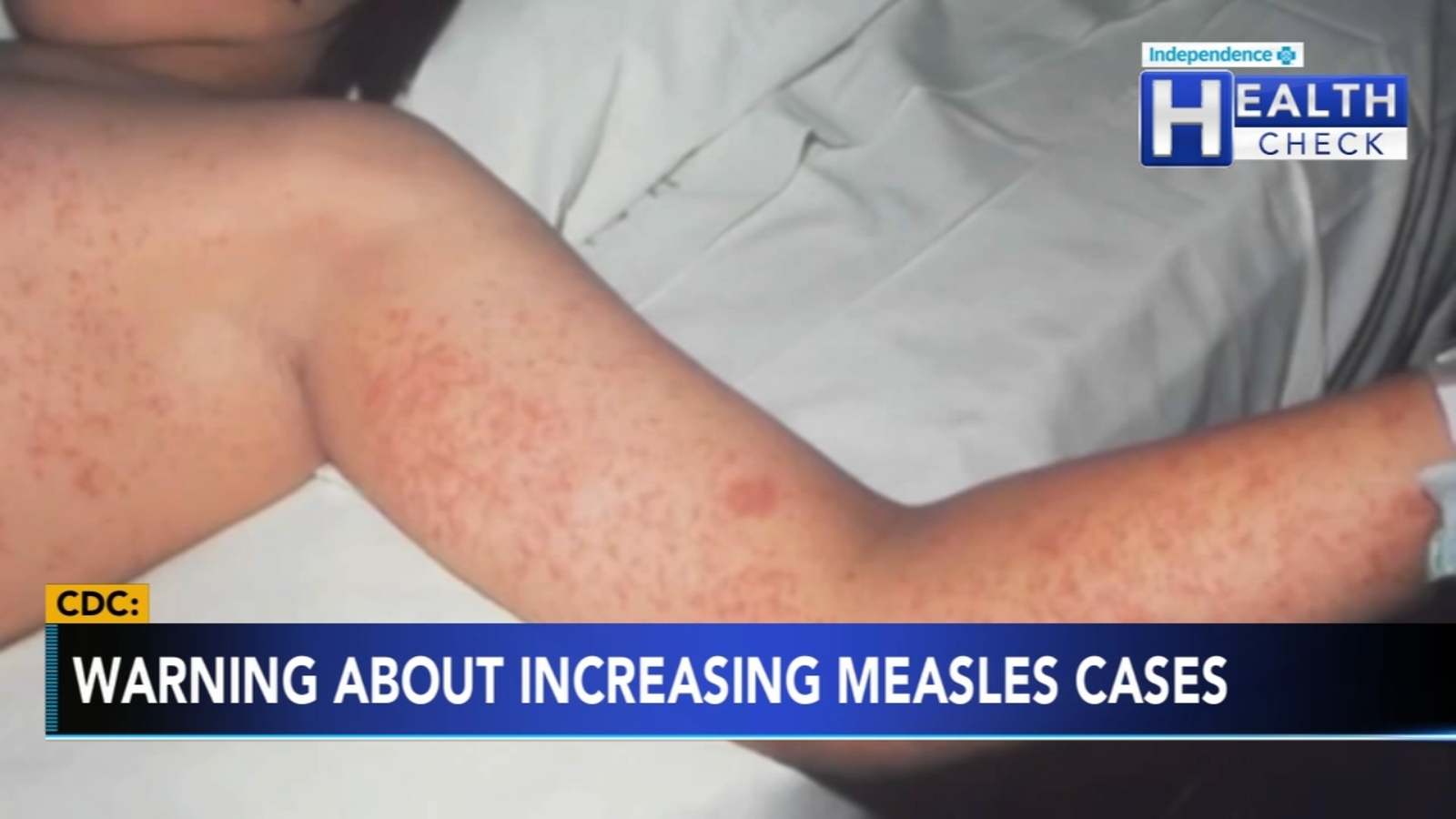 2025 Measles Cases In Virginia: Second Case Underscores Public Health Concerns 2025 Measles Cases In Virginia: Second Case Underscores Public Health Concerns