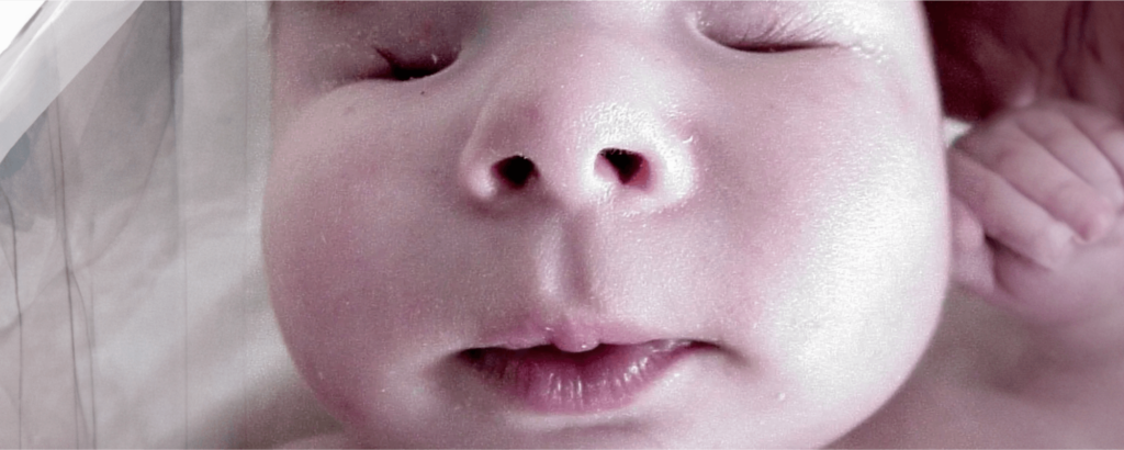 Bilateral Anophthalmia: Understanding The Rare Condition Of Babies Born Without Eyes Bilateral Anophthalmia: Understanding The Rare Condition Of Babies Born Without Eyes