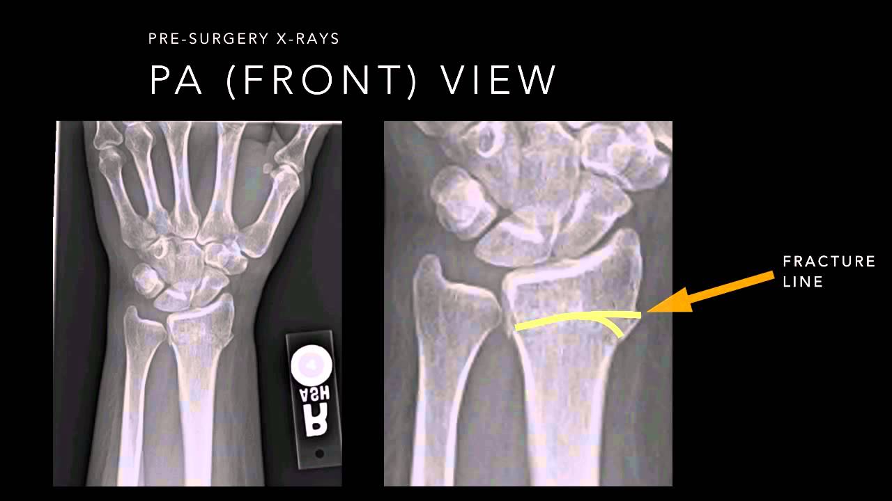 Jayson Tatum's Wrist Injury: X-Rays Show No Fracture After Playoff Fall Jayson Tatum's Wrist Injury: X-Rays Show No Fracture After Playoff Fall
