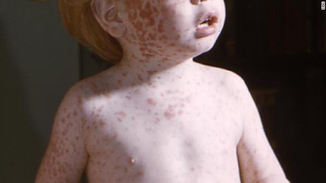 Measles Cases In The US Rise To 1,046: Indiana Outbreak Concludes Measles Cases In The US Rise To 1,046: Indiana Outbreak Concludes