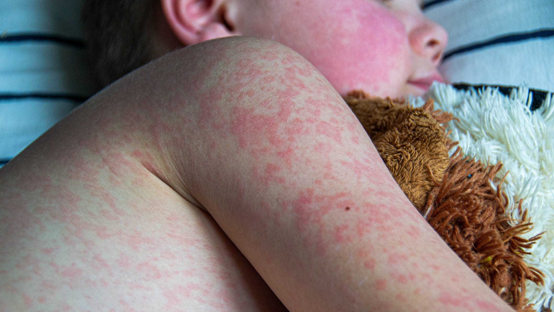 Measles Cases Rise In Israel Linked To Texas Outbreak Measles Cases Rise In Israel Linked To Texas Outbreak