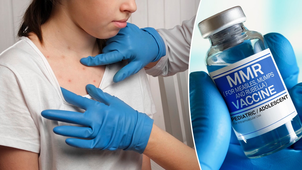 Measles Outbreak In North Dakota: School Quarantine For Unvaccinated Children Measles Outbreak In North Dakota: School Quarantine For Unvaccinated Children