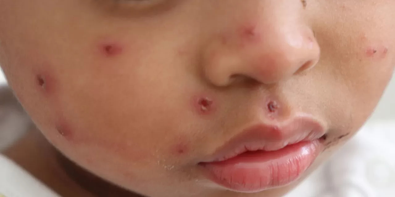 Measles Outbreak Spreads Across Israel Following Texas Case Measles Outbreak Spreads Across Israel Following Texas Case