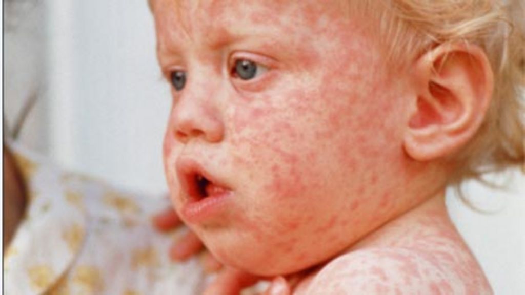 Rising Measles Cases In Kansas: Understanding The Resurgence Rising Measles Cases In Kansas: Understanding The Resurgence
