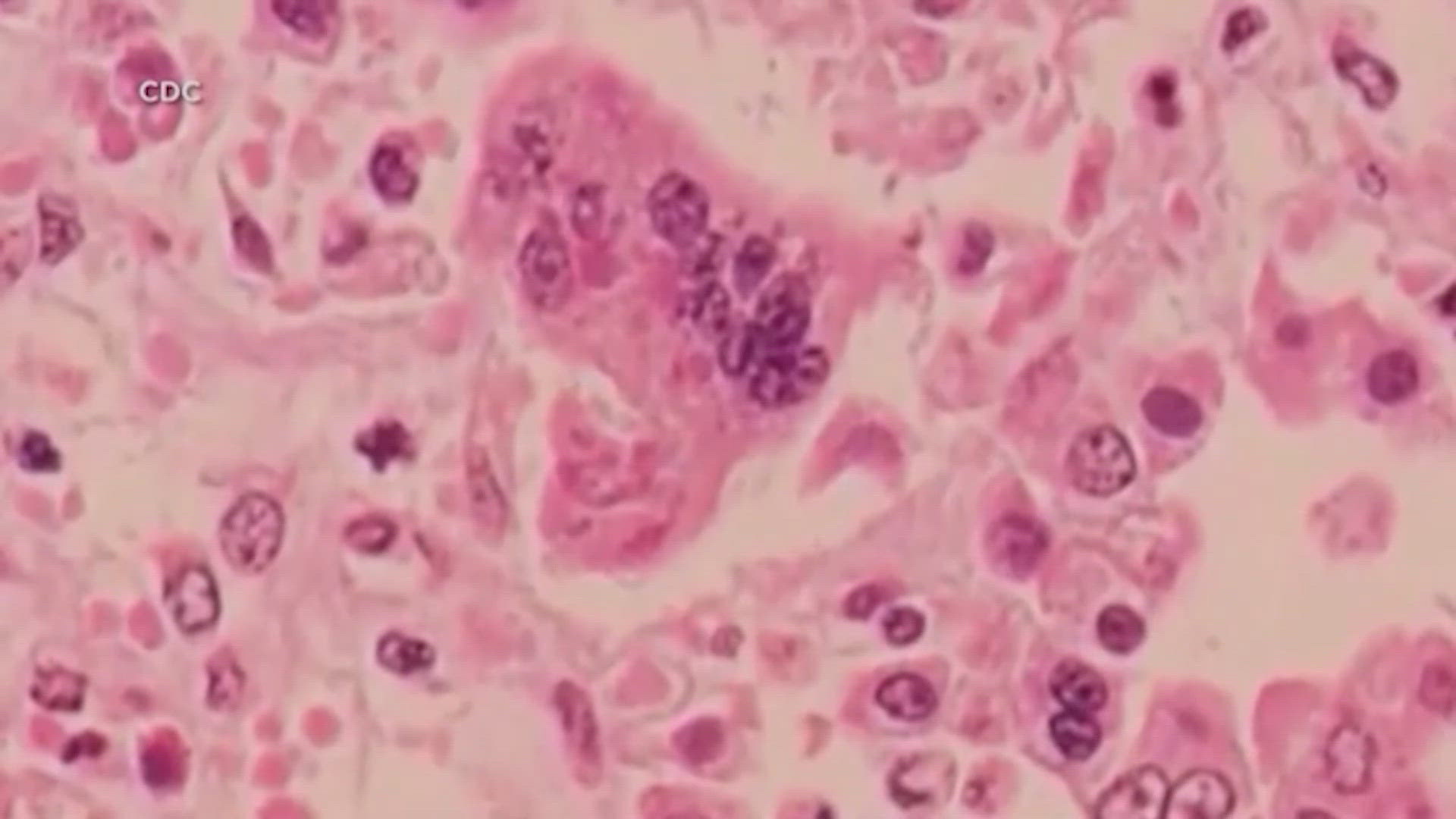 Texas Measles Cases Surge: New Infections Unrelated To Known Outbreak Texas Measles Cases Surge: New Infections Unrelated To Known Outbreak