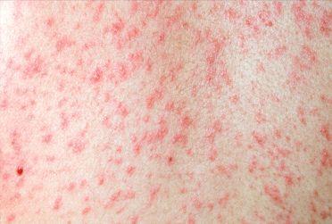 The Threat Of Measles: Could Canada Lose Its Elimination Status This Fall? The Threat Of Measles: Could Canada Lose Its Elimination Status This Fall?