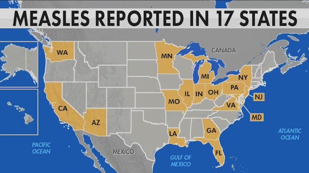 US Measles Cases Increase Slightly To 1,046, Indiana Outbreak Over US Measles Cases Increase Slightly To 1,046, Indiana Outbreak Over